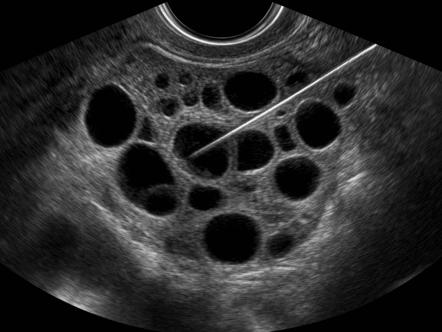 Aspiração folicular